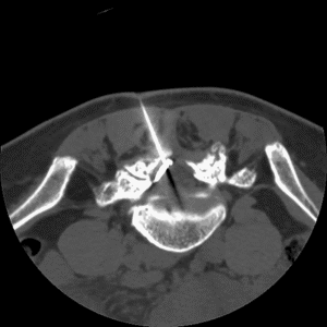 Infiltration épidurale au niveau lombaire
