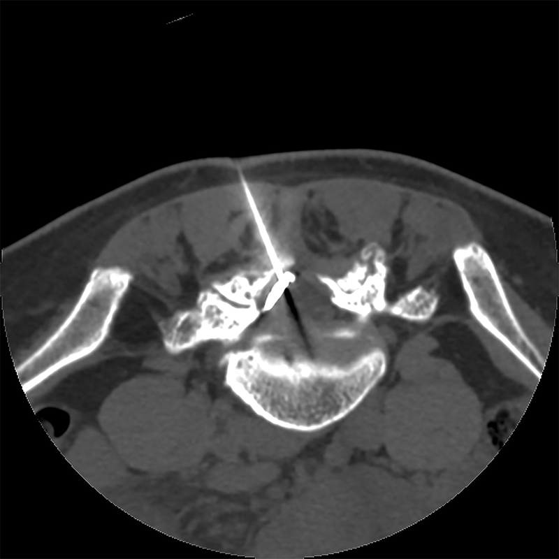 Infiltration épidurale au niveau lombaire